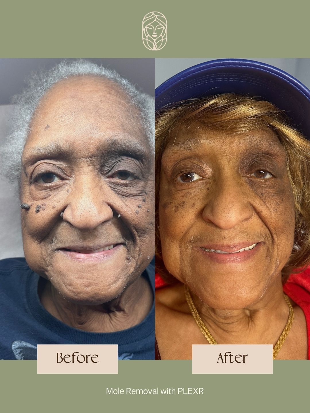 Before and after comparison showing mole removal results on a person’s face using PLEXR treatment.