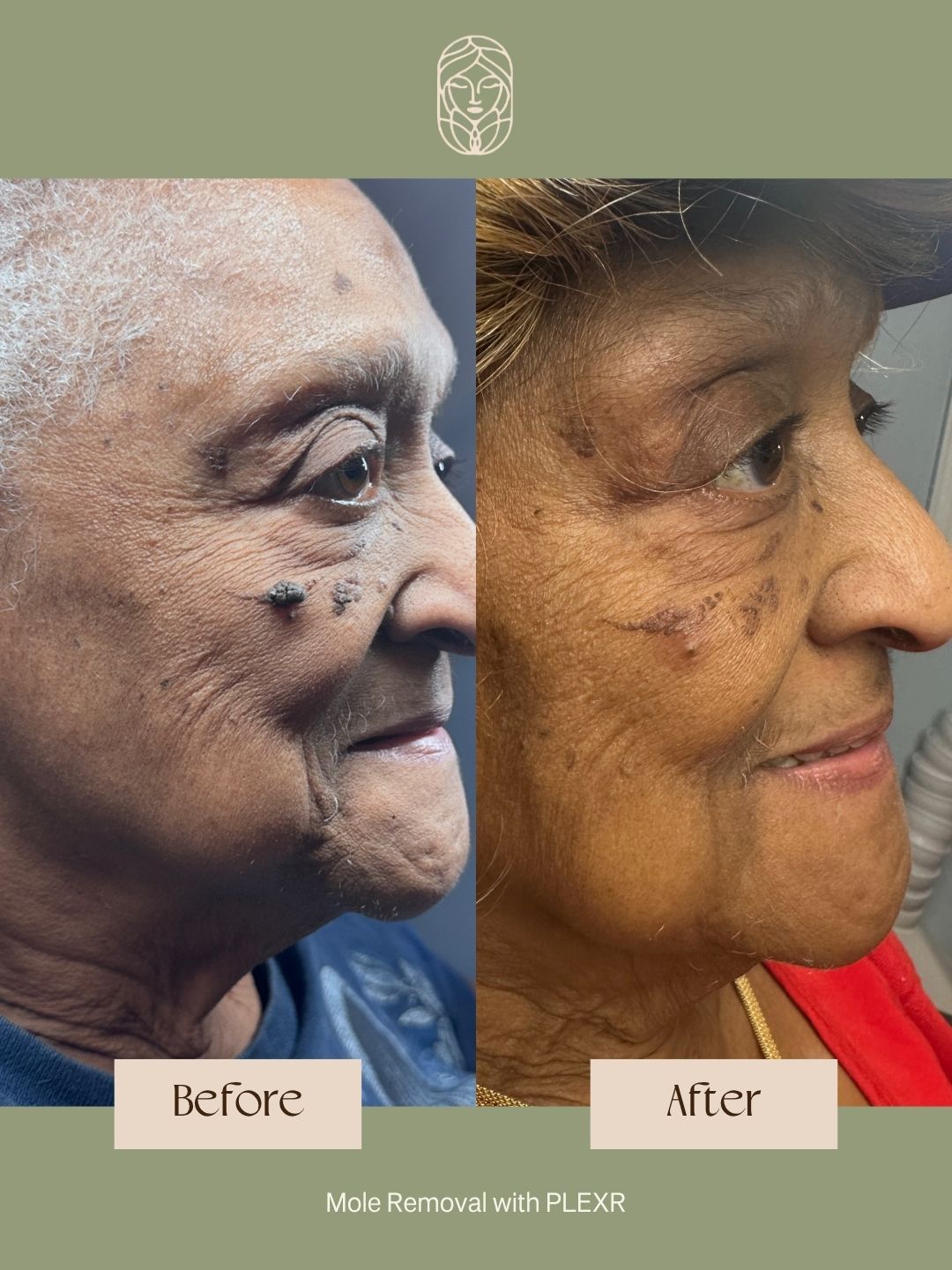 Before and after comparison showing mole removal from a person's cheek using PLEXR technology.