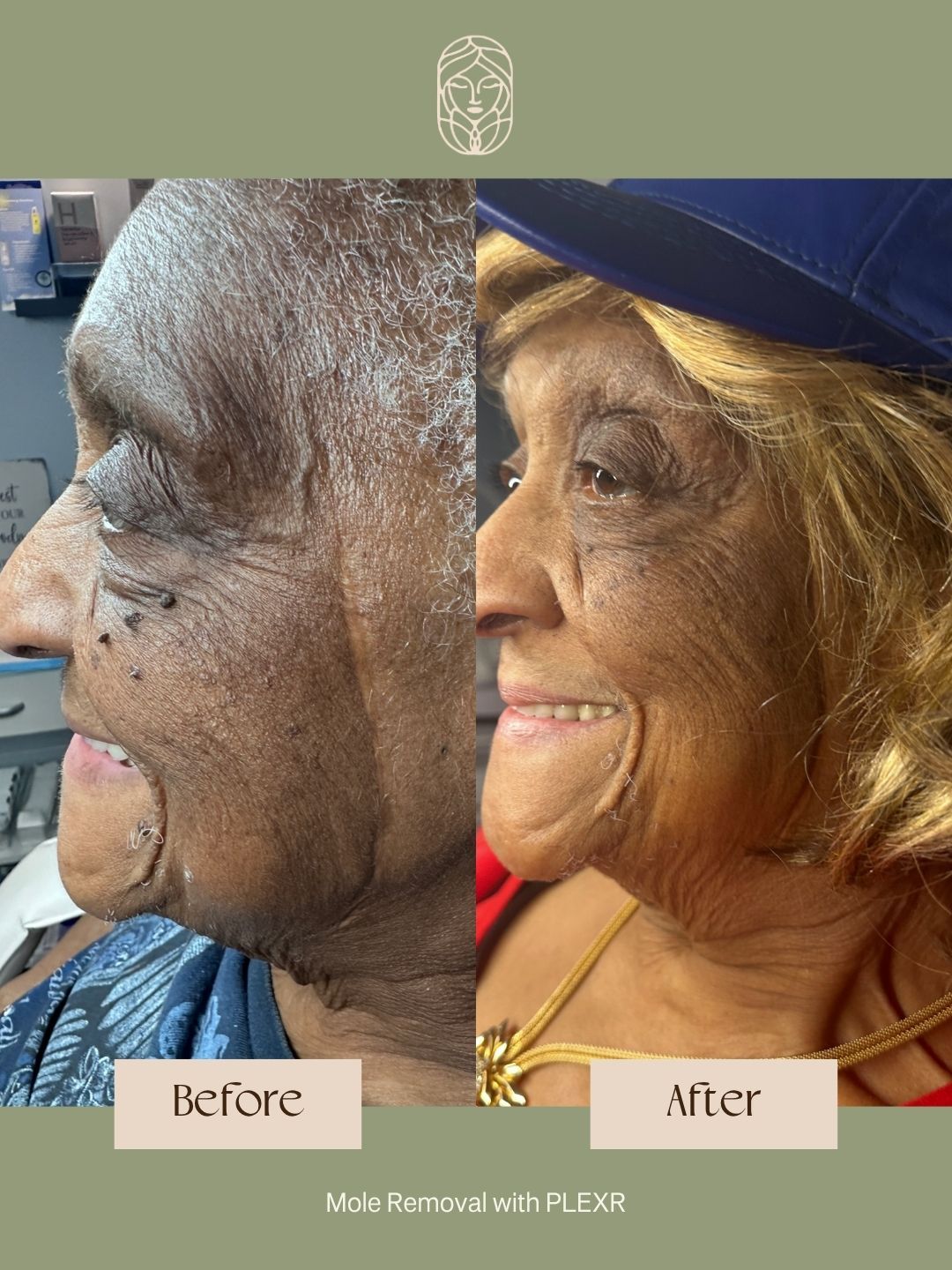 Before and after comparison showing facial skin after mole removal with PLEXR treatment.