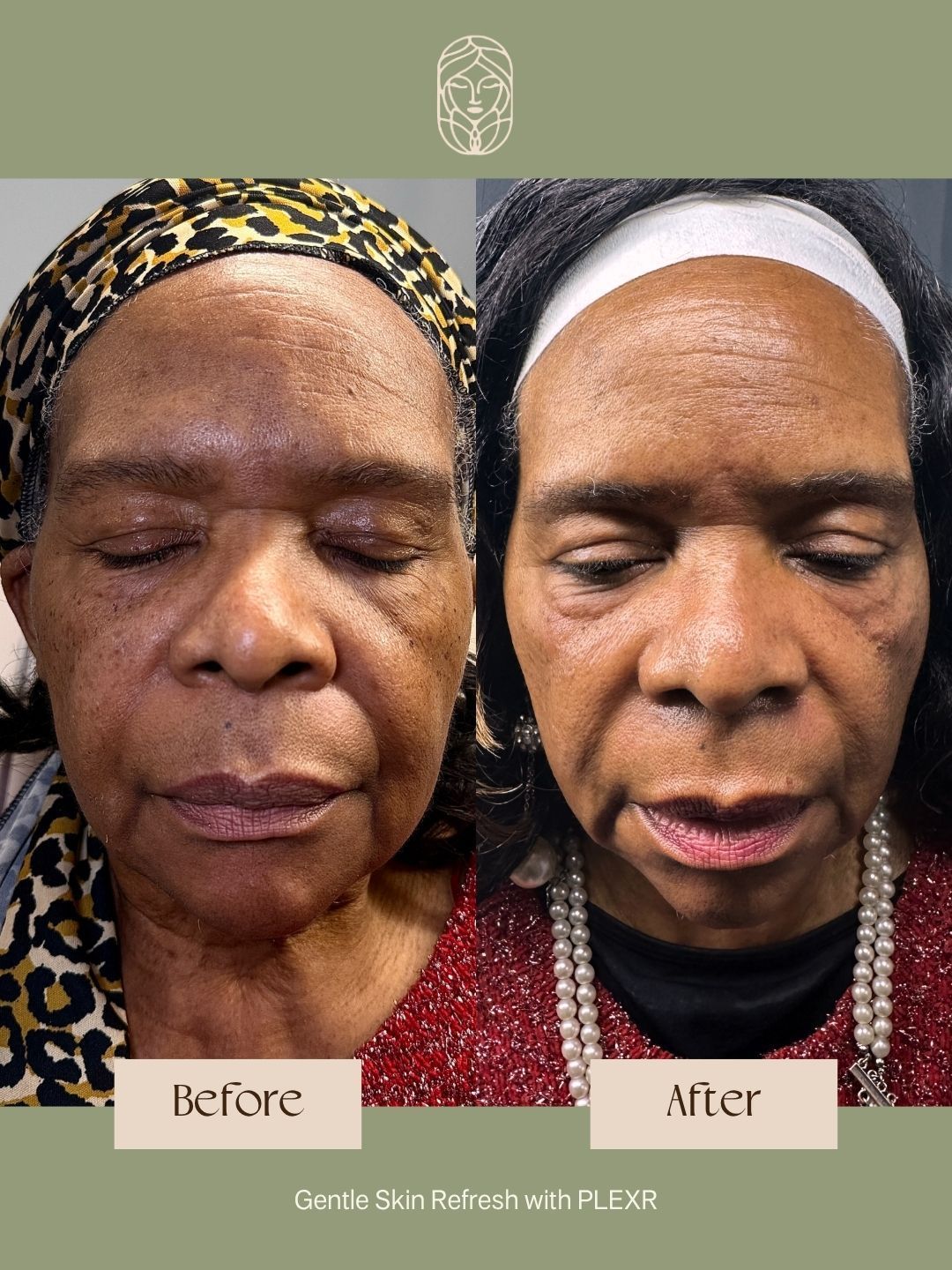 Before and after photos of a person’s face demonstrating the results of a PLEXR skin treatment.