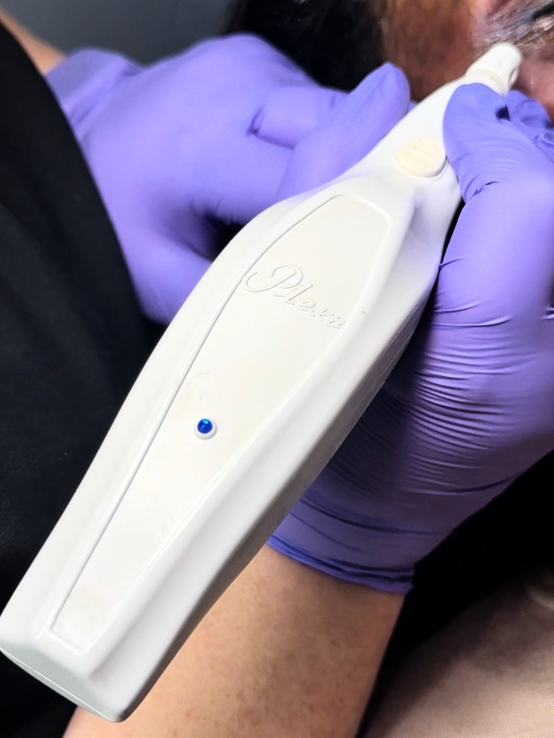 A gloved hand holds a white cosmetic laser device against a person's skin to perform a skin treatment.
