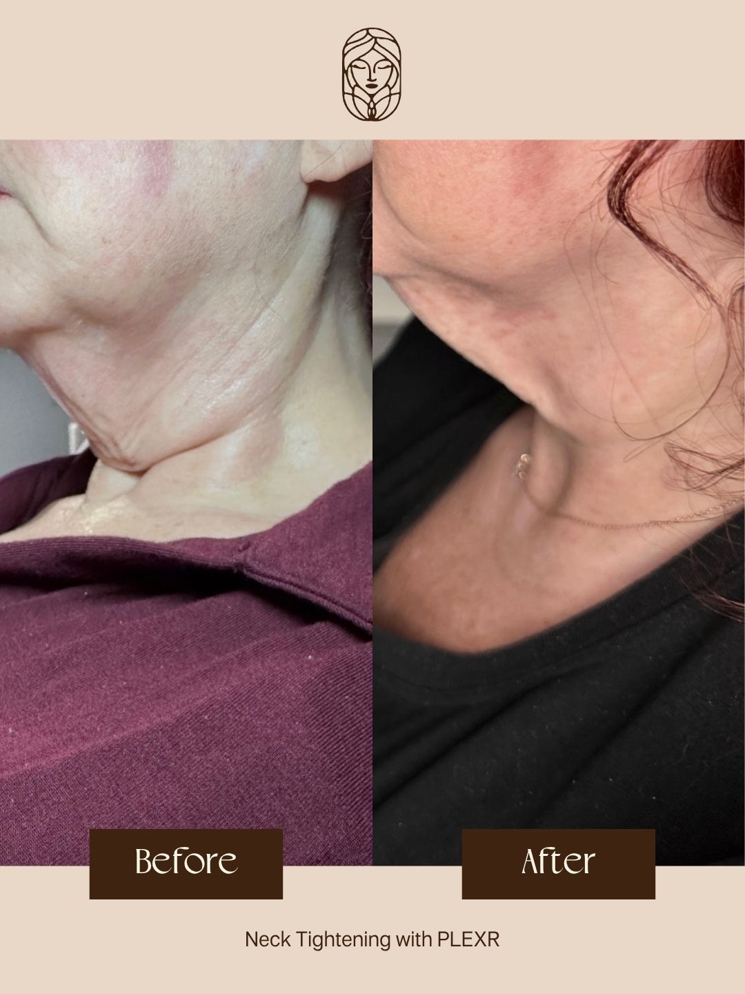 Before-and-after comparison showing neck skin tightening results from a PLEXR cosmetic procedure.