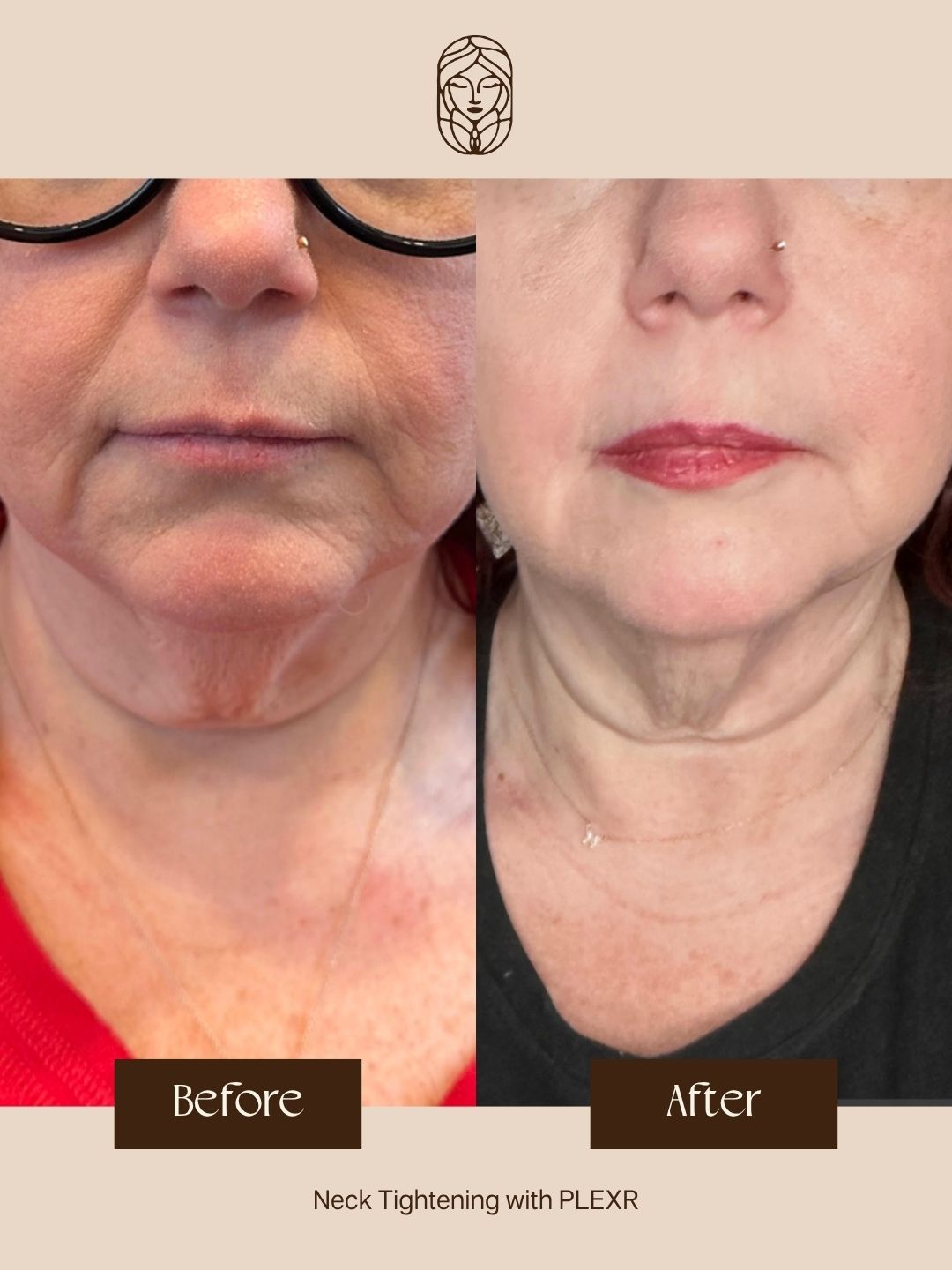 A side-by-side comparison showing neck skin before and after PLEXR tightening treatment.