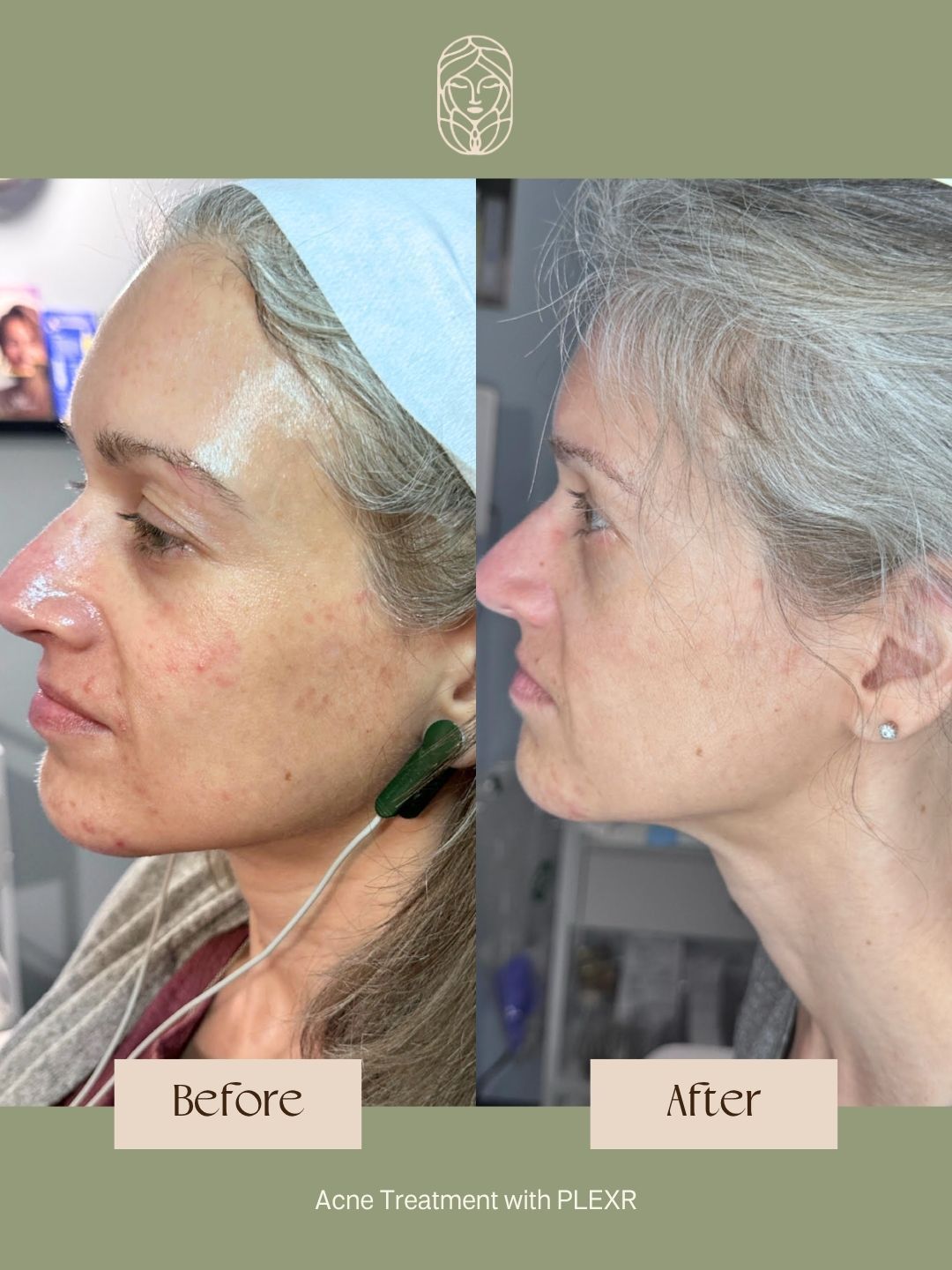 Before and after comparison of skin texture improvements after an acne treatment, showing a profile view of a face.