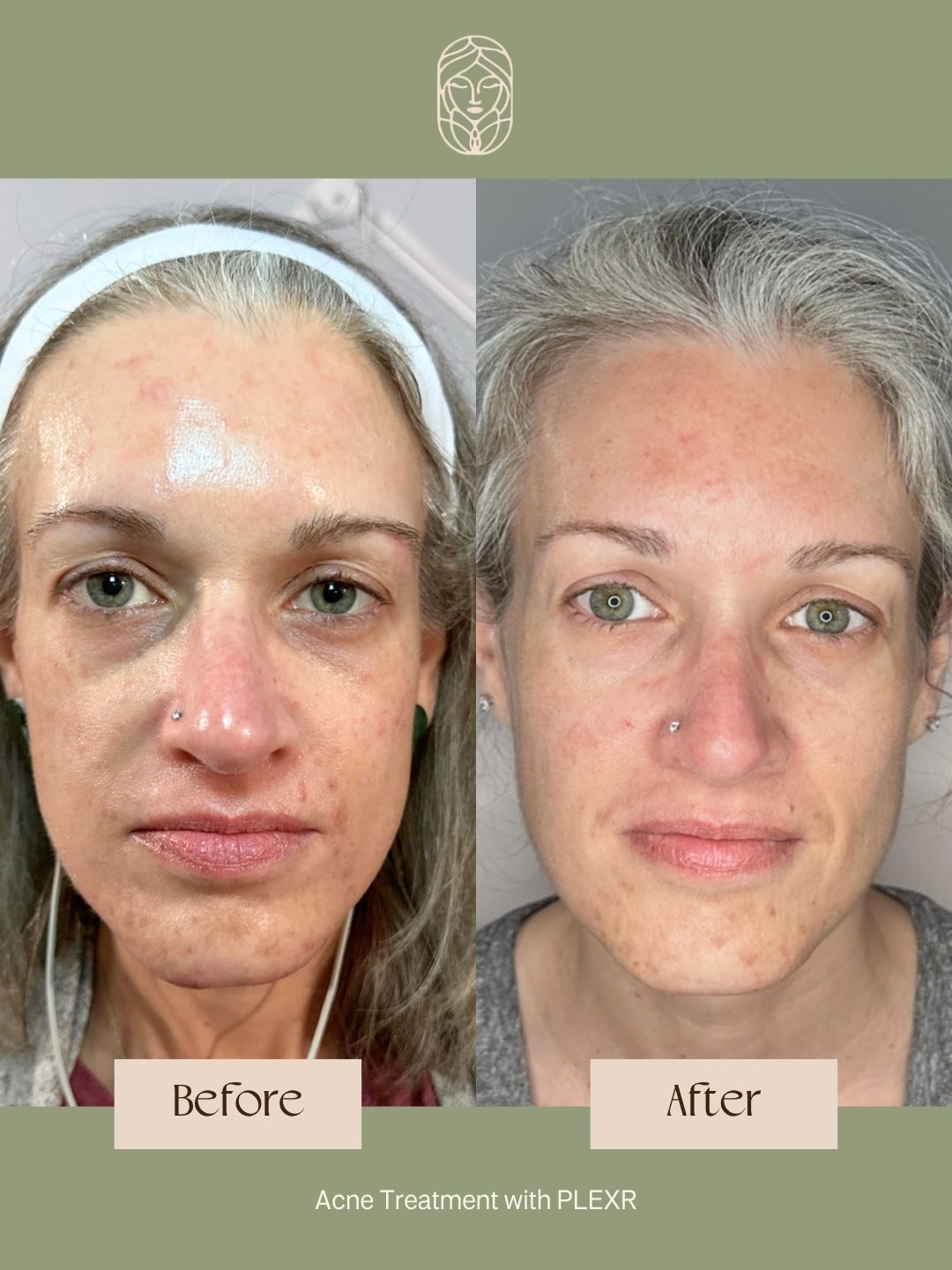 Before and after photos showing facial skin improvement after an acne treatment.