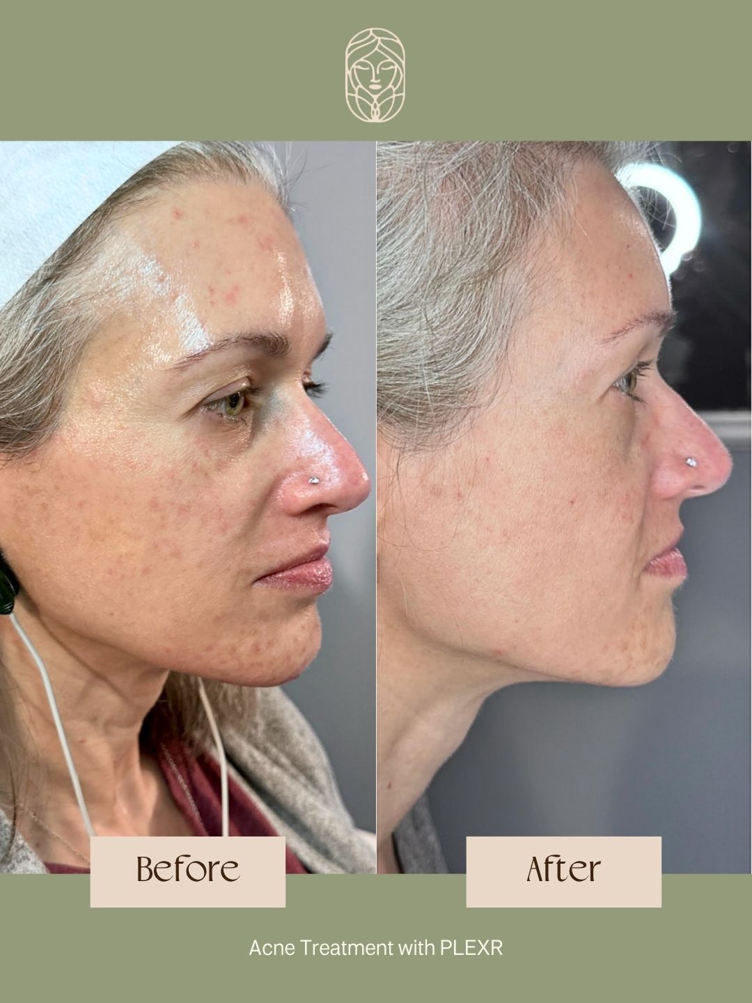 Before and after photos showing skin improvement on the side of a person's face after an acne treatment.