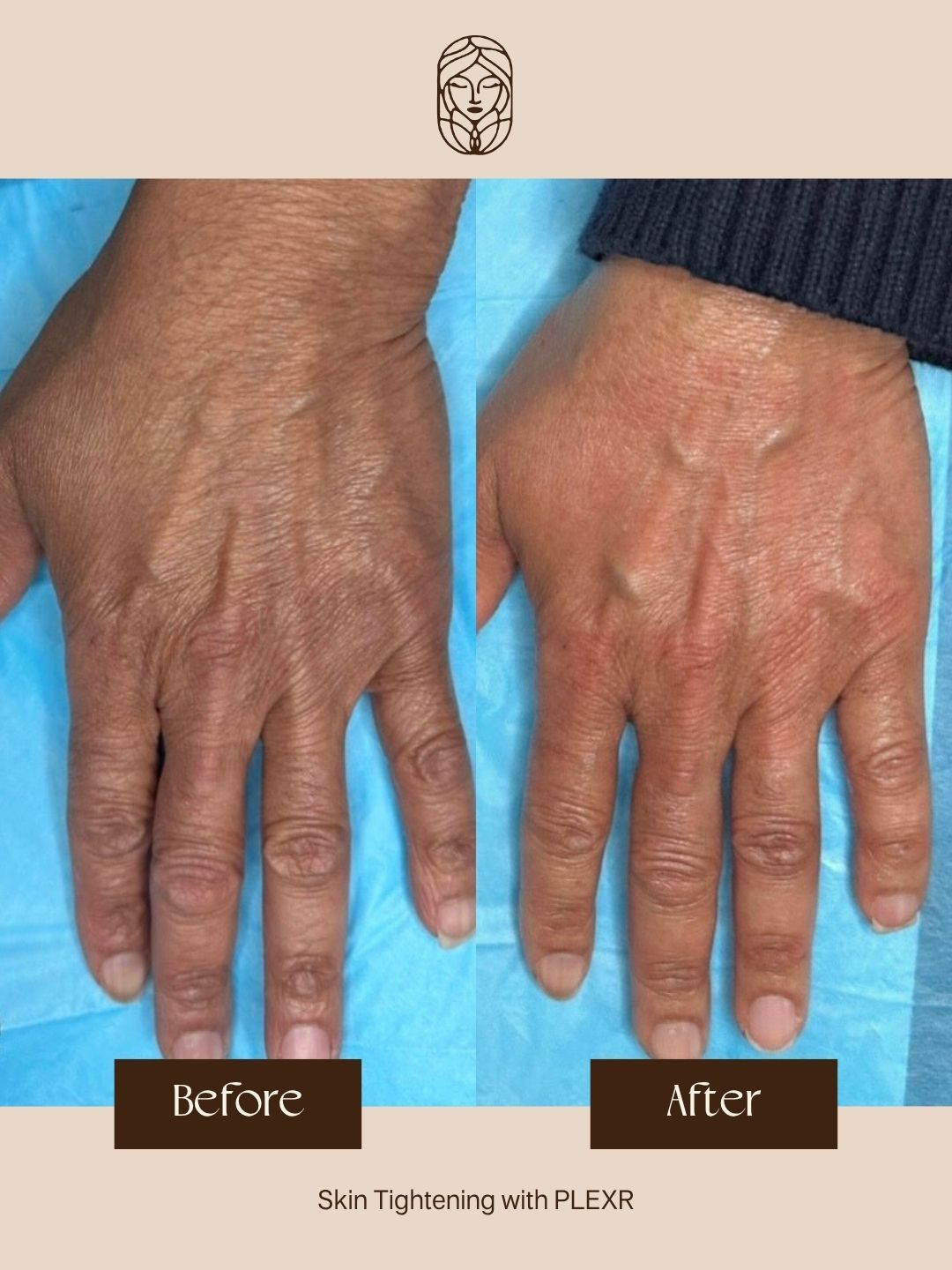 A side-by-side comparison of a hand before and after skin tightening treatment, showing smoother, firmer skin texture.