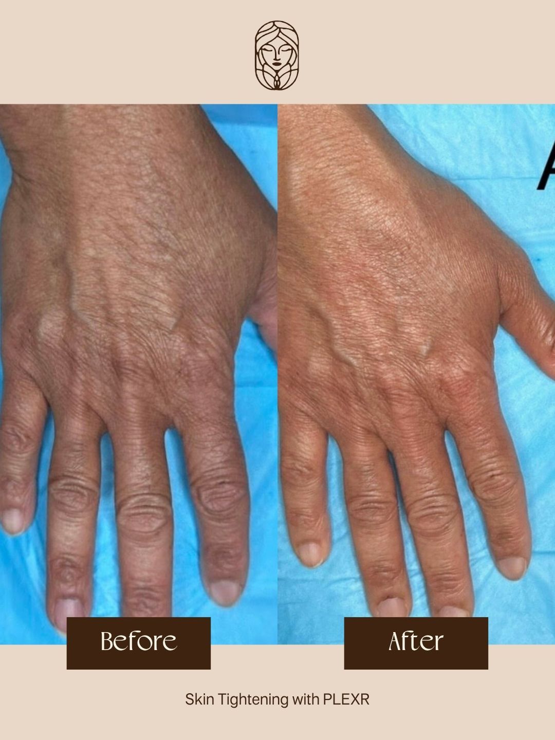 Before-and-after comparison of a hand showing skin tightening results from a FLEXR treatment.
