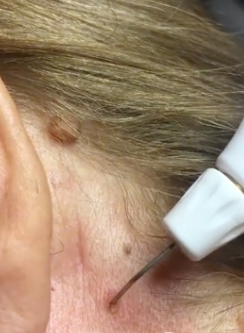 Needle injecting into skin near neck and ear of a person with blonde hair.