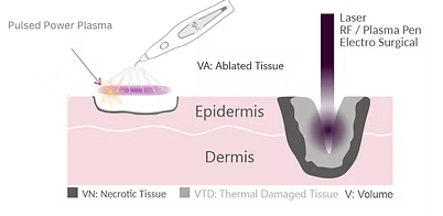 Diagram: Pulsed power plasma ablation on skin layers (epidermis and dermis), with necrotic and thermal-damaged tissue zones indicated.