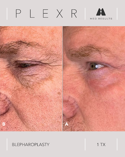Before and after photos of a man's eye area. Left shows wrinkles, right shows smoother skin after Plexr blepharoplasty.