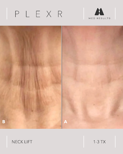 Comparison of neck lift results using Plexr: Before (B) neck with wrinkles vs. After (A) smoother neck.