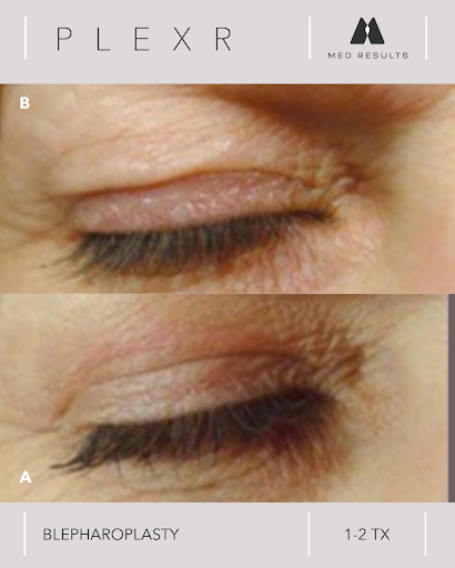 Before and after of an eye, showing the effects of Blepharoplasty. The top eyelid appears tightened in the lower image.