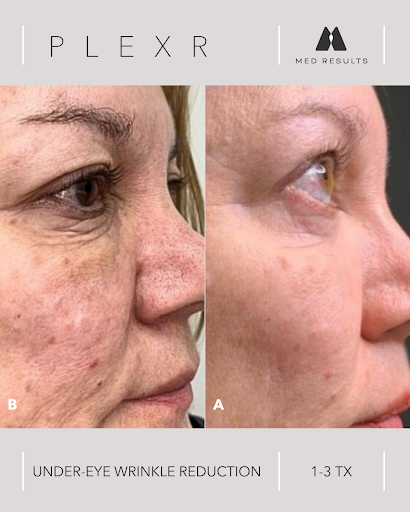 Before/after photos: Plexr treatment reduces under-eye wrinkles. Side profile of a woman's face, skin appears smoother.