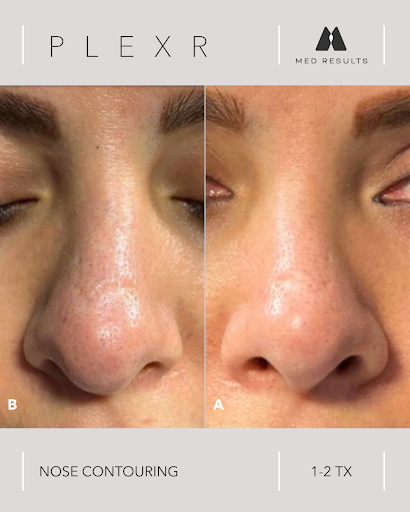 Before and after of a woman's nose. Plexr nose contouring reduces visible bumps.