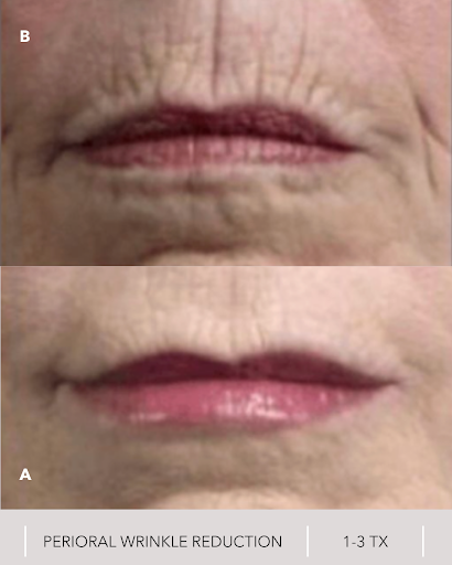 Comparison of wrinkled lips (top) before treatment and smoother lips (bottom) after perioral wrinkle reduction.