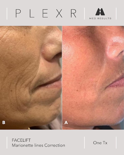 Before-and-after photo showing Plexr treatment results. Left side shows Marionette lines. Right side shows improved skin.
