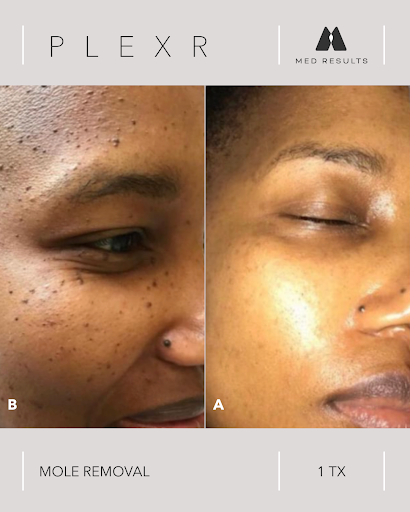 Before and after photos of a person's face after mole removal with Plexr treatment.