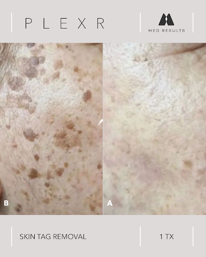 Before and after comparison of skin showing skin tag removal using Plexr treatment.