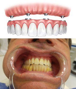 All-on-4 dental implants london