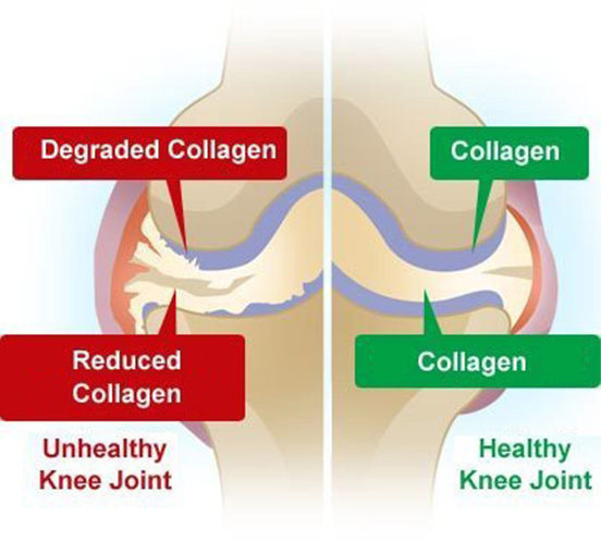 Diagram comparing unhealthy and healthy knee joints, illustrating degraded/reduced vs. healthy collagen.
