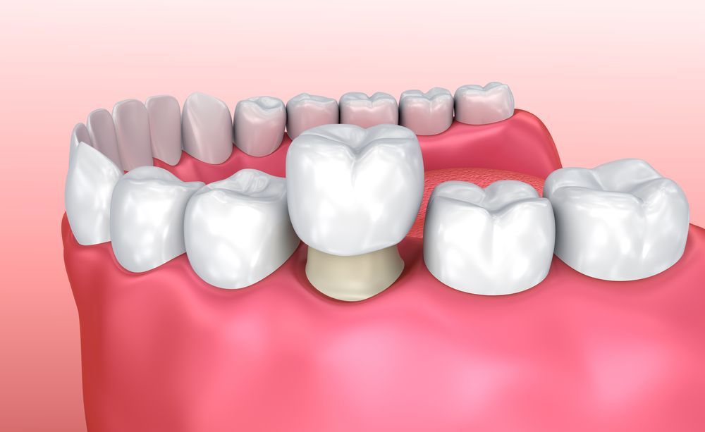 Dental illustration: a tooth with a crown, surrounded by other teeth and gum, pink background.