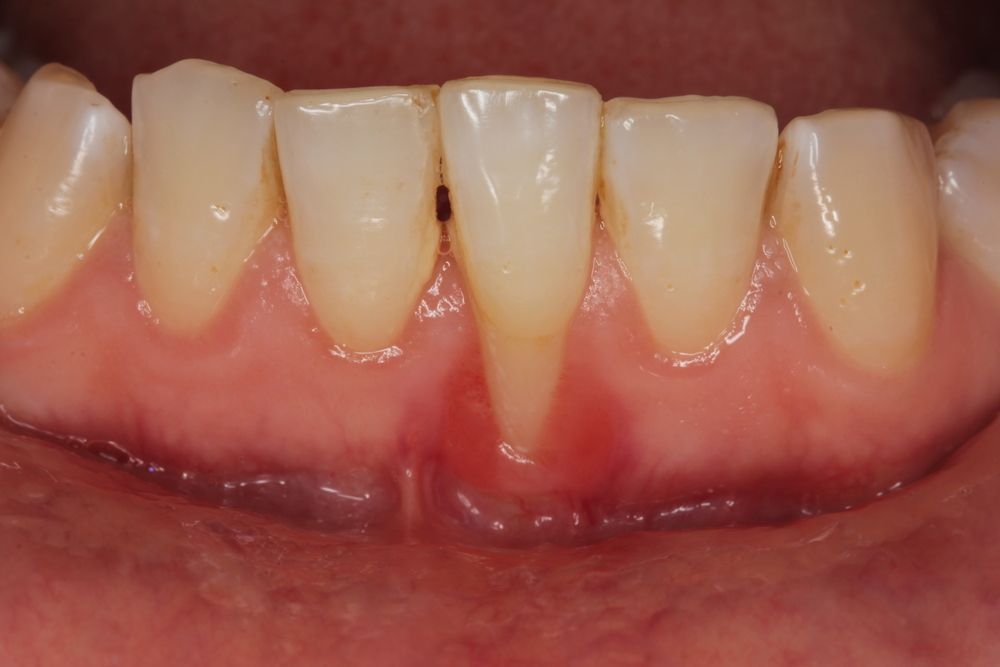 Close-up of teeth and gums showing mild gum inflammation and recession.