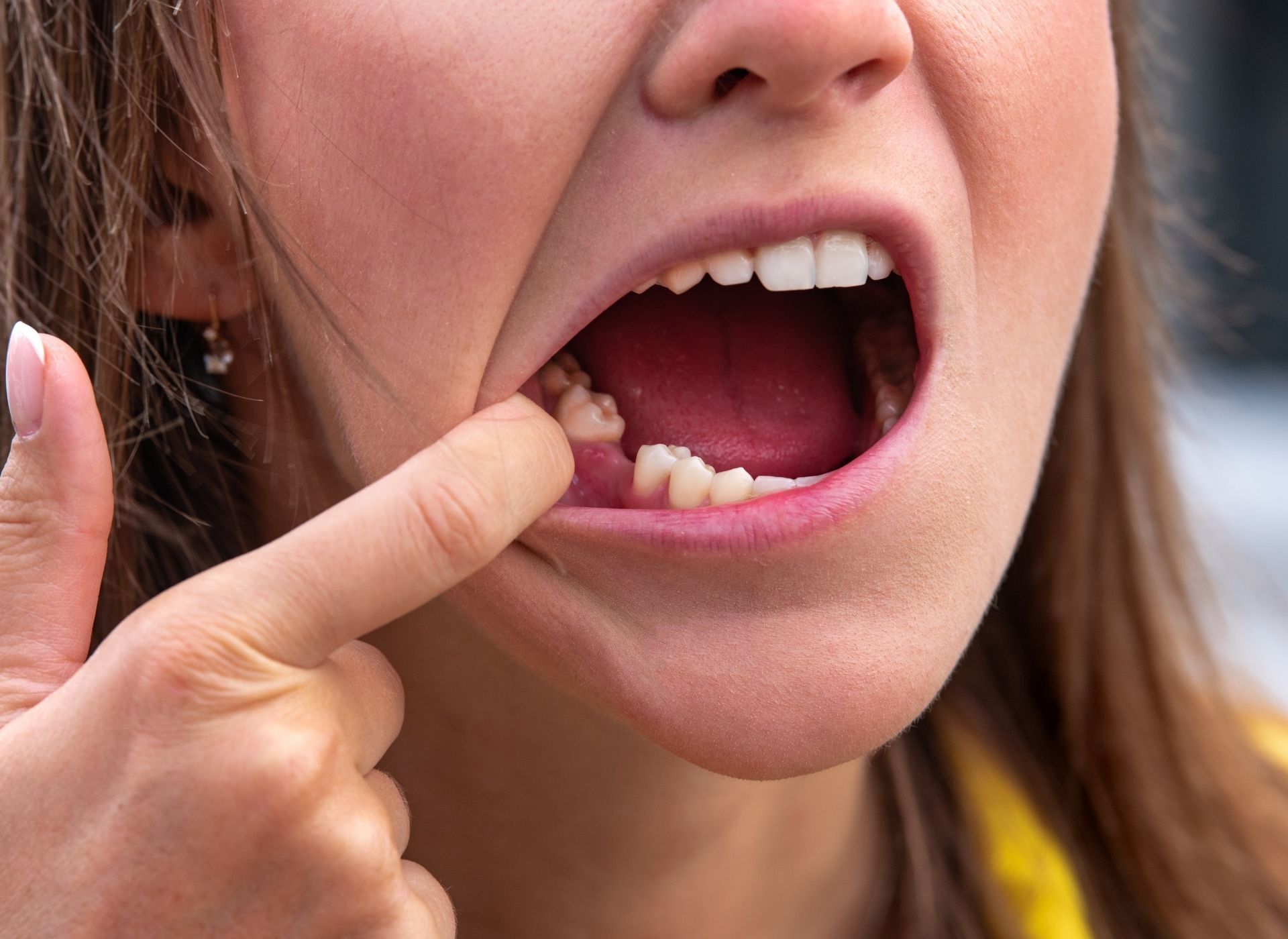 Woman pointing at missing tooth, mouth open in distress.