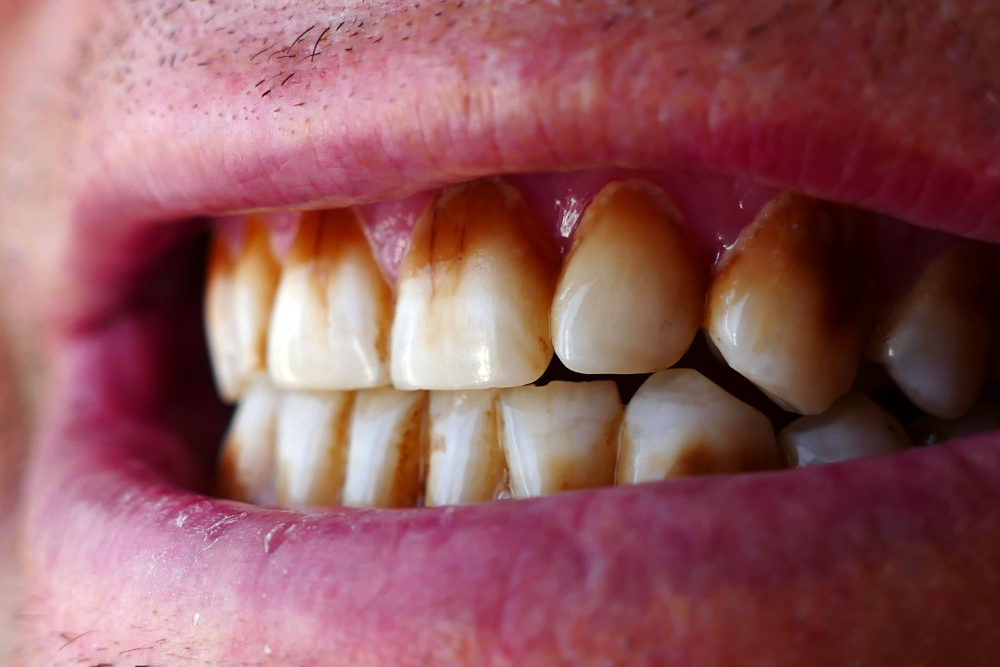 Dark or Yellow Teeth? We Can Help in Metairie