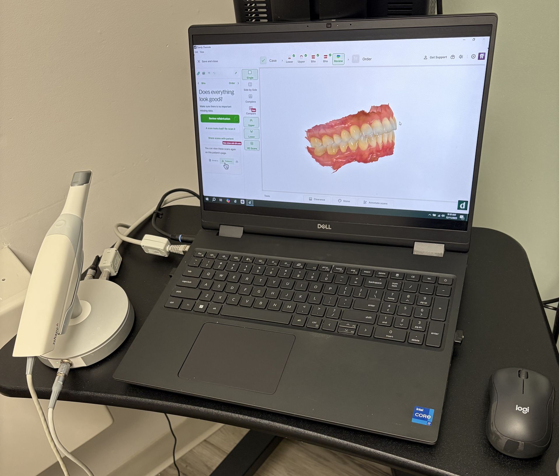 Dental scanner connected to a laptop displaying a 3D model of teeth.