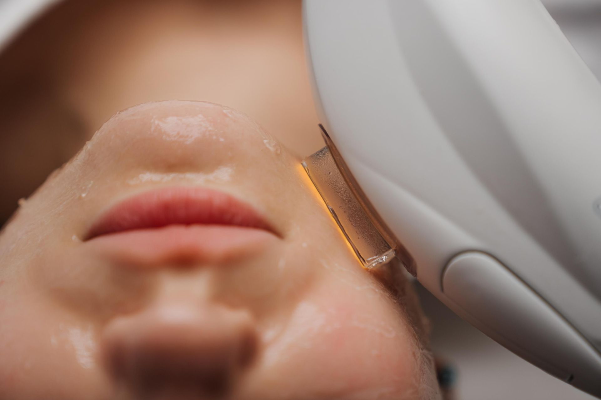 A Woman is Getting a Laser Treatment on Her Face — Xtreme Rejuvenation Clinic, Medispa & Beauty Therapy In Maryborough, QLD