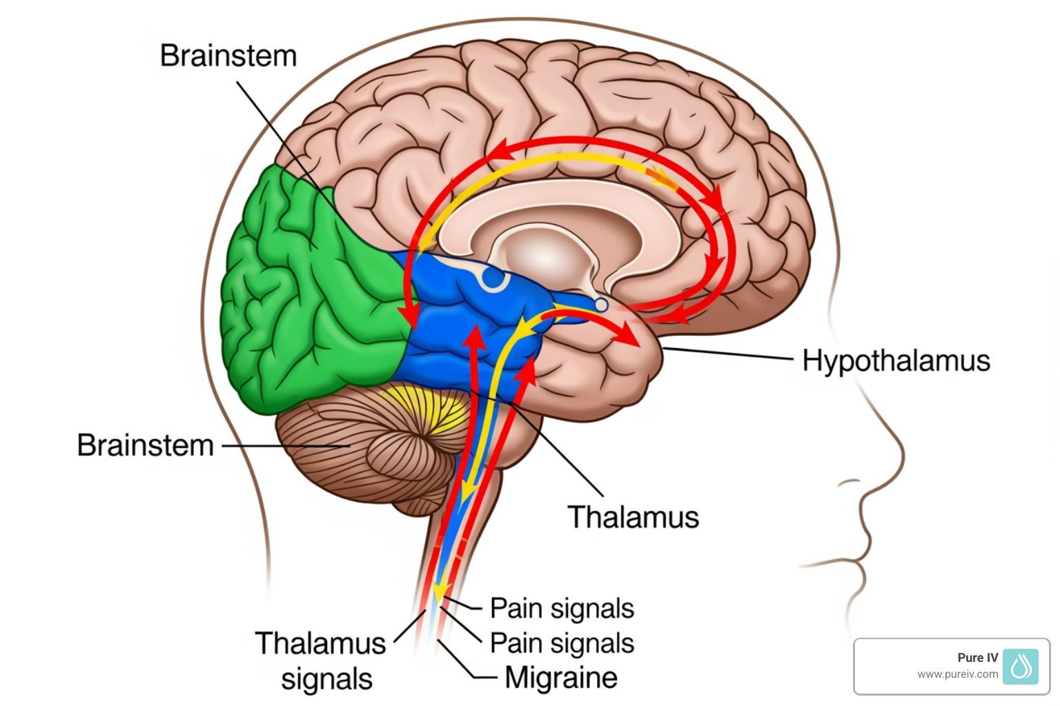 A side-view diagram of a human brain showing color-coded pathways representing pain signals related to a migraine.