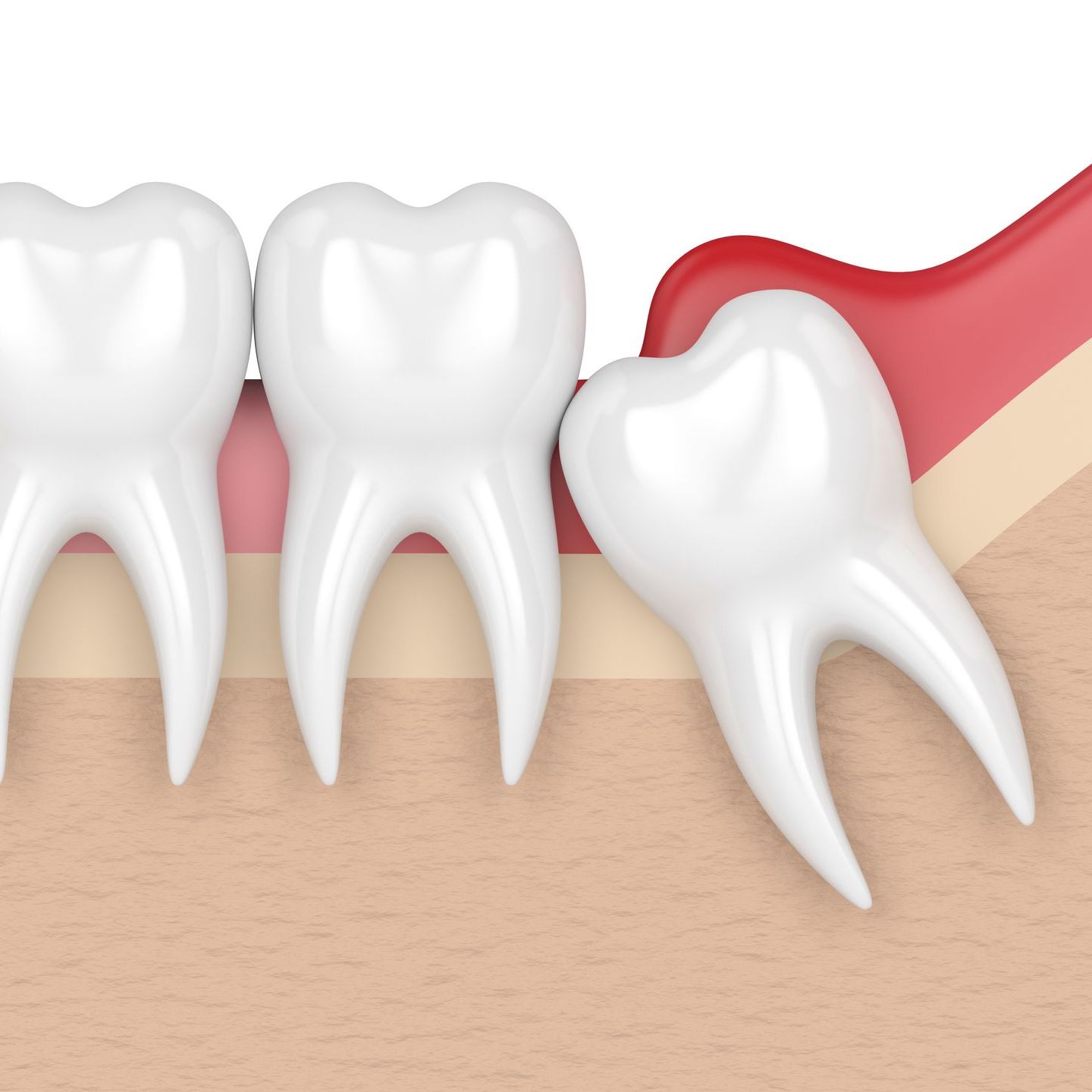 impacted tooth