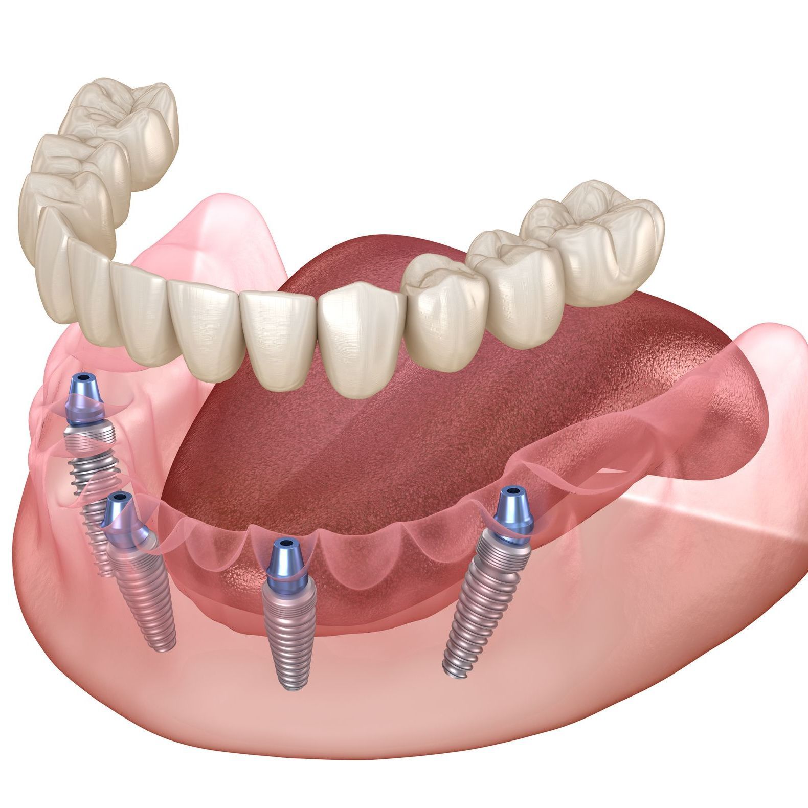 all on 4 implant