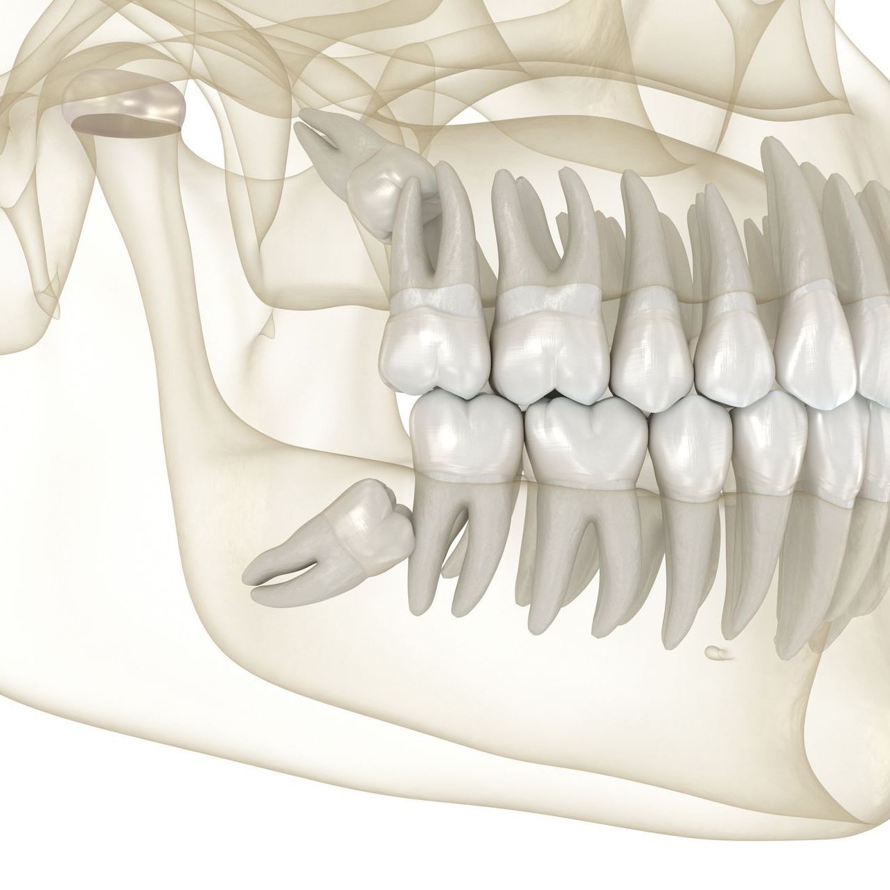 wisdom tooth extractions