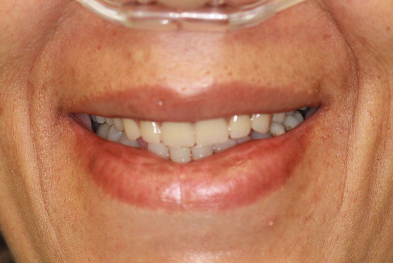 Teeth before dental implant