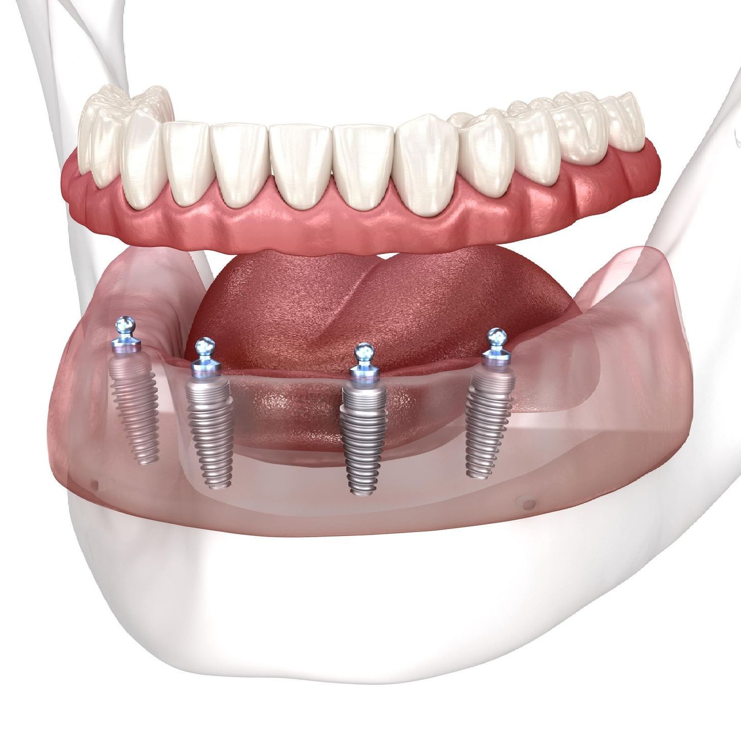 Implant-Retained Dentures