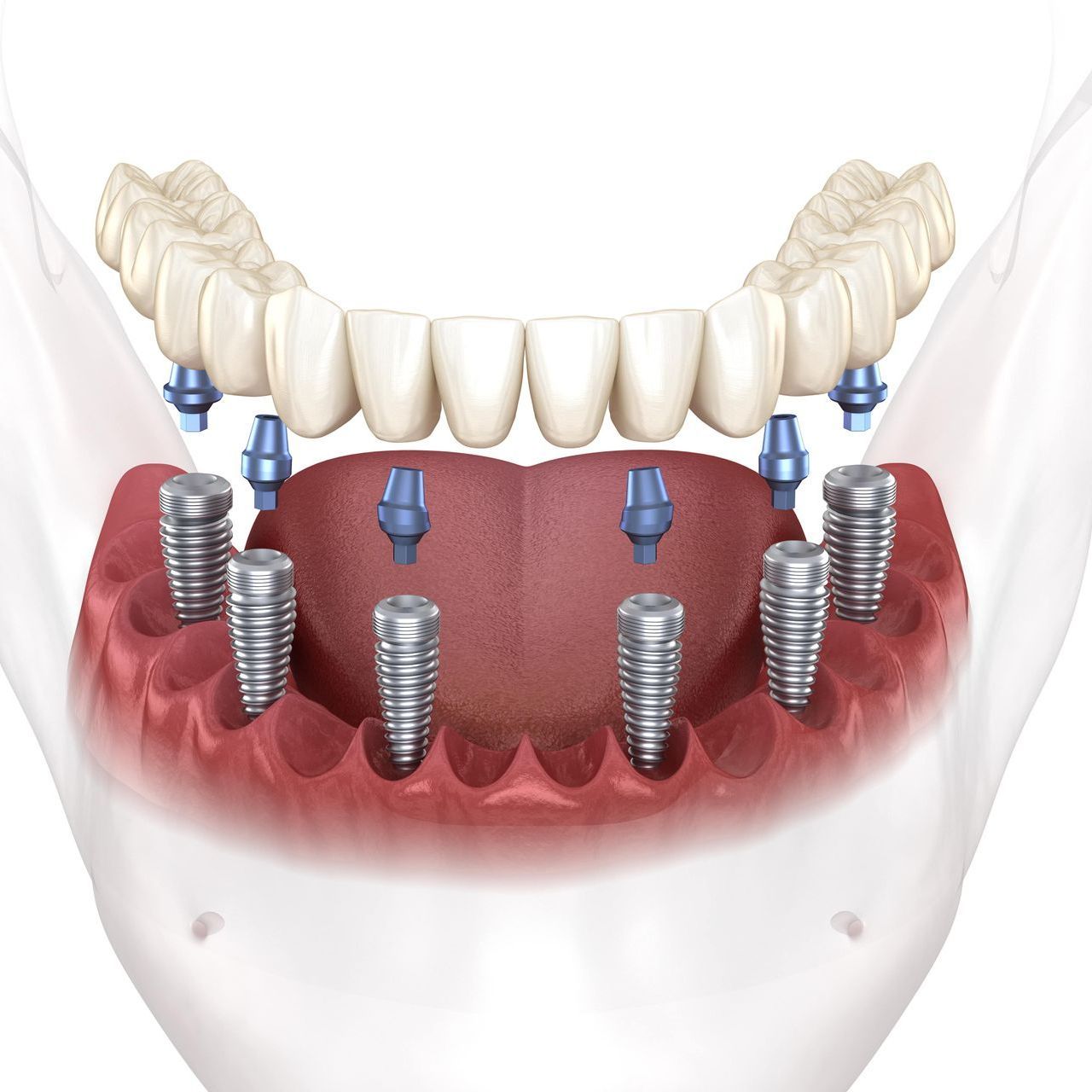 Implant-supported dentures