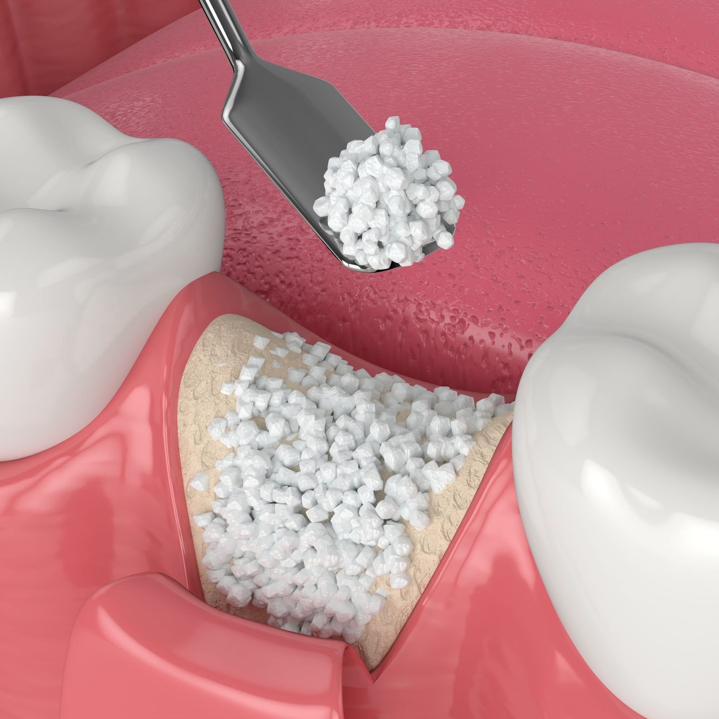 Bone grafting