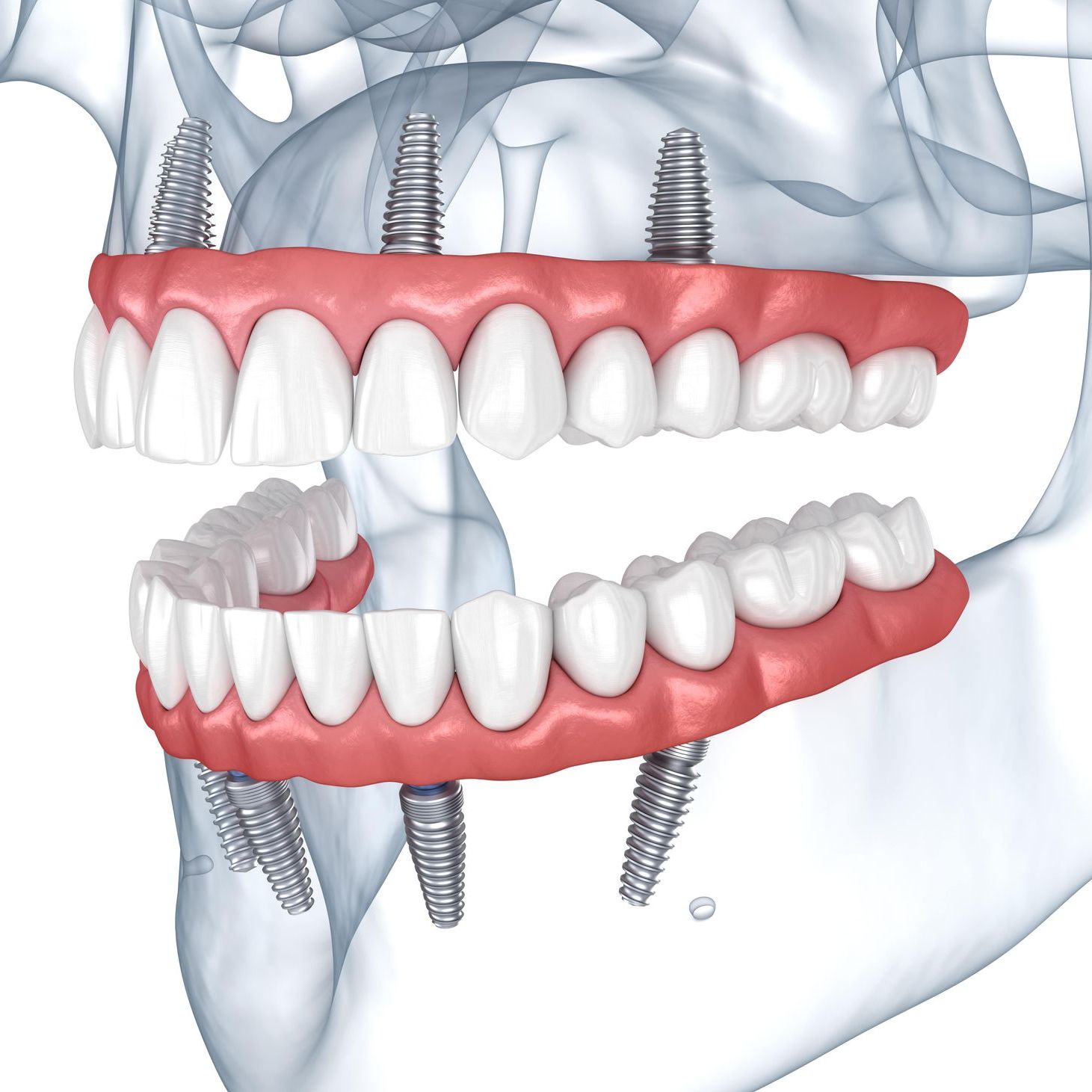 full mouth reconstruction