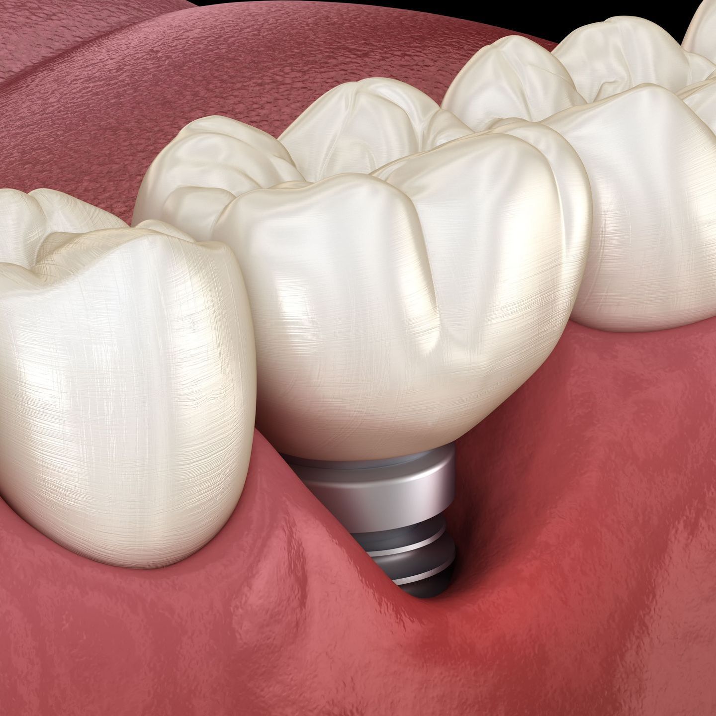 failing dental implants