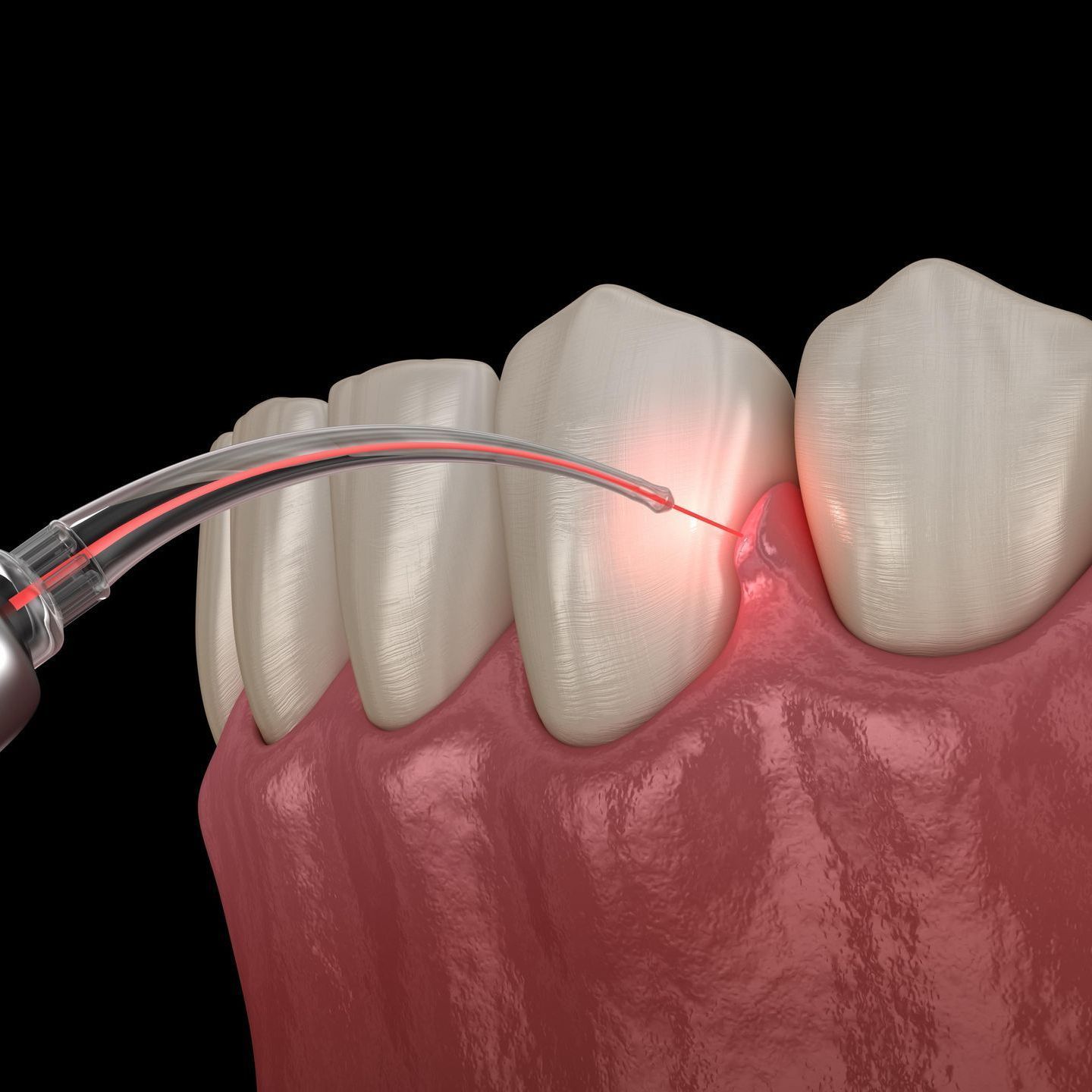 A close up of a tooth being treated with a laser.