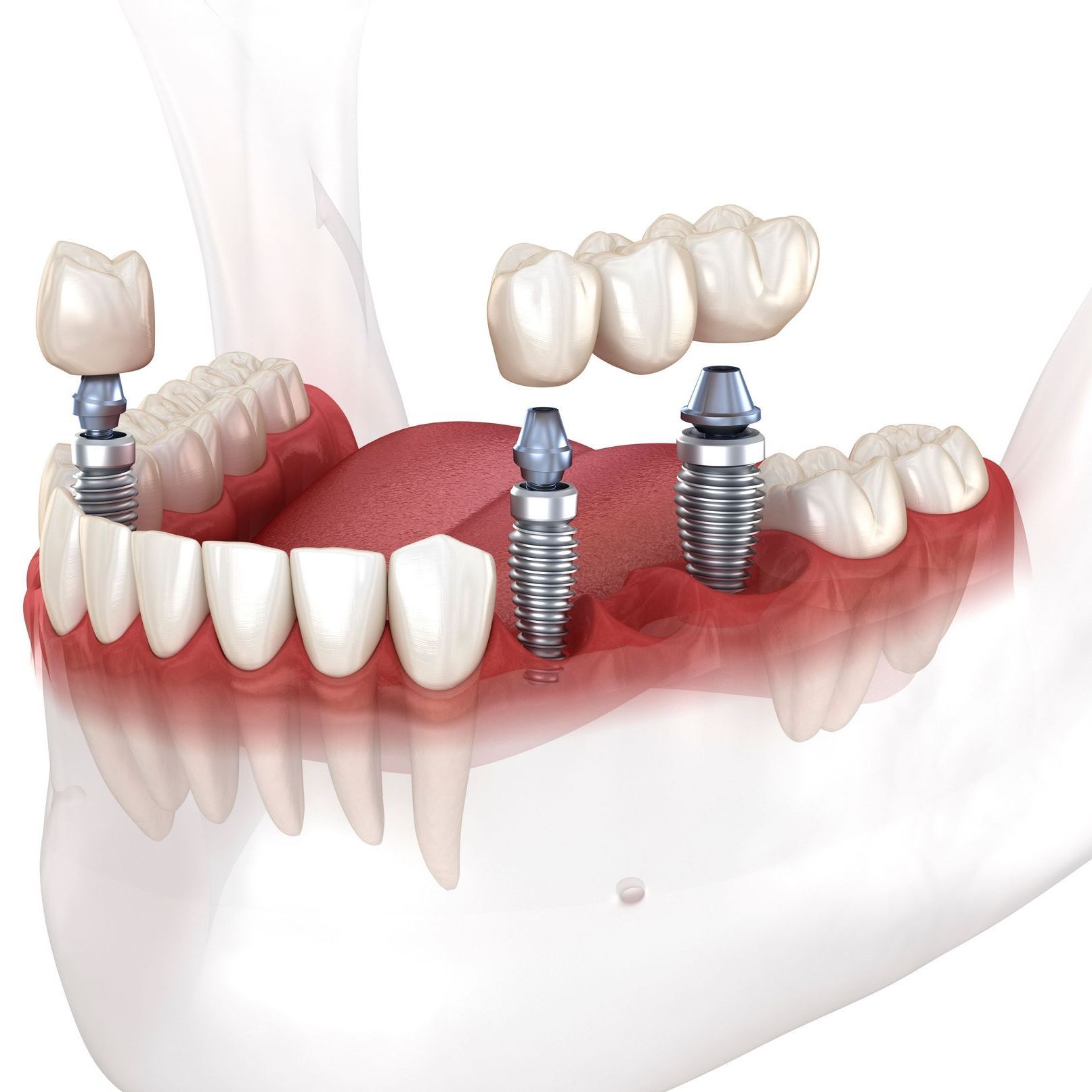 multiple tooth implants