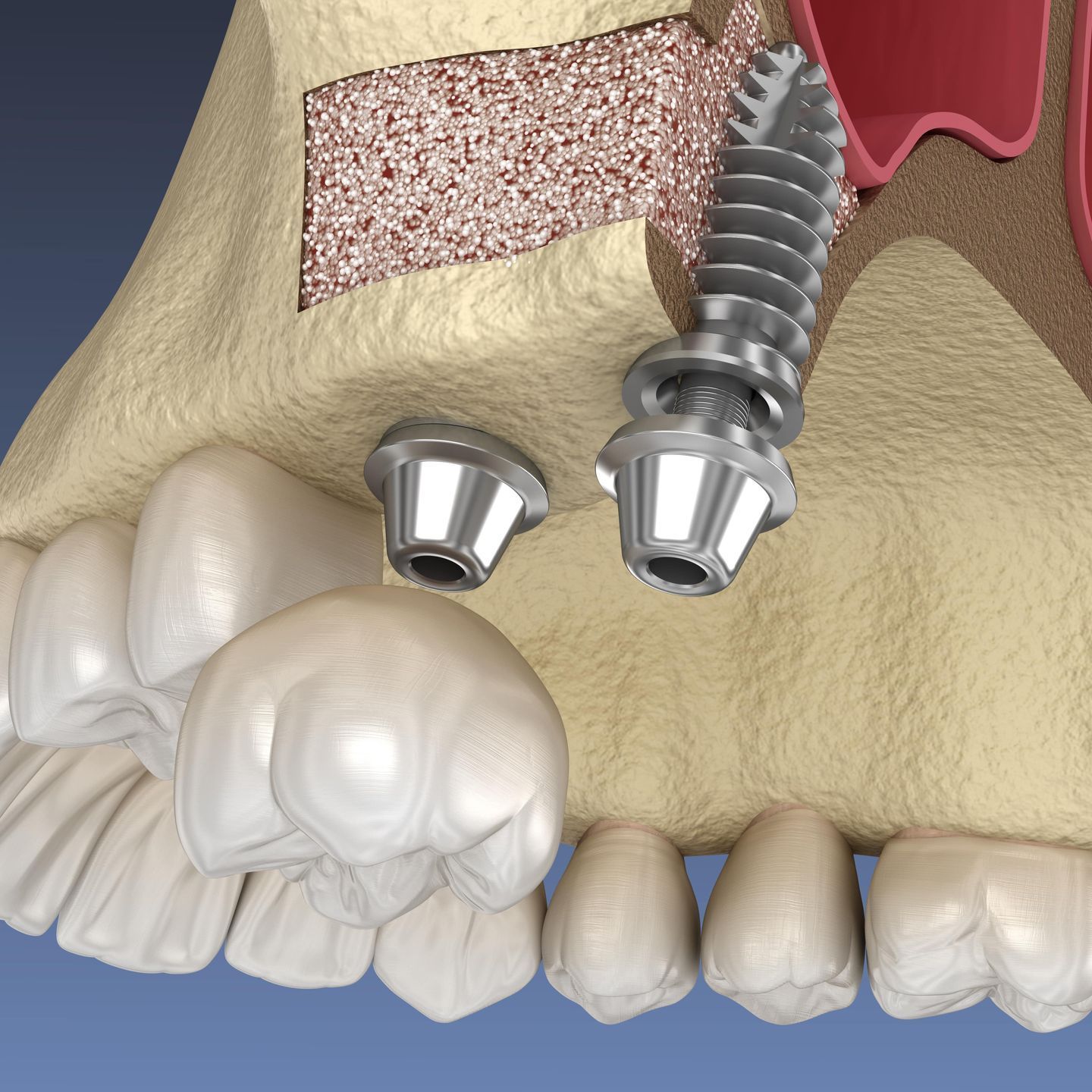 sinus lift