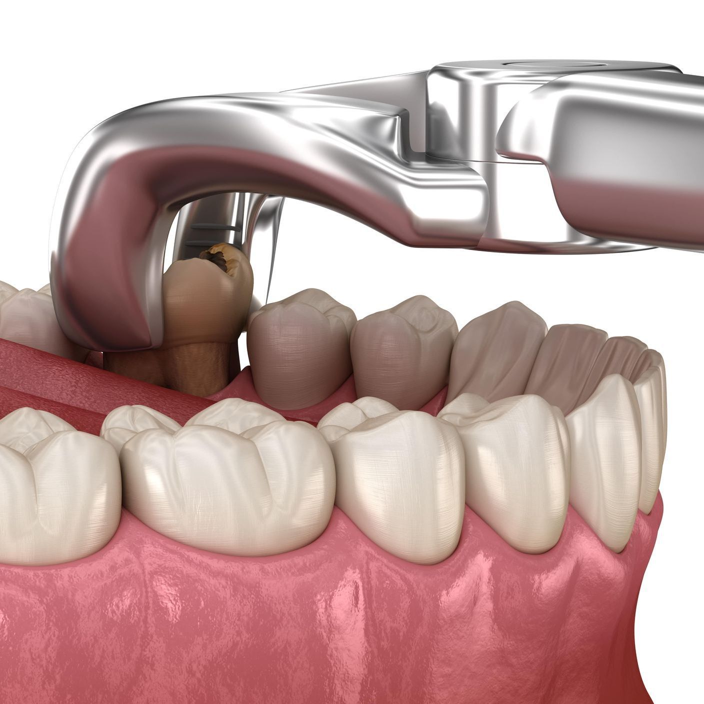 a computer generated image of a denture with two dental implants