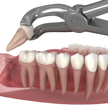 A wisdom tooth being extracted