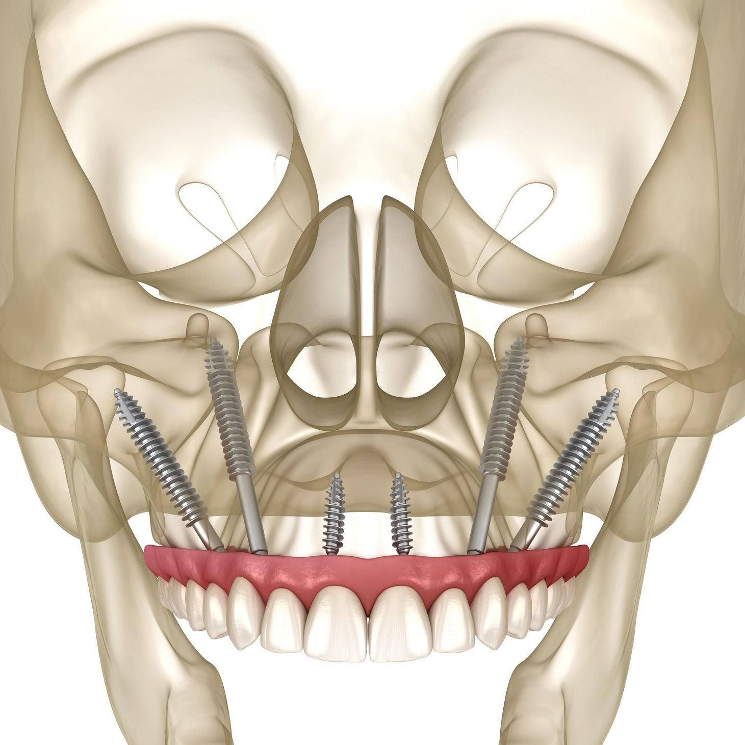 Zygomatic Dental Implants