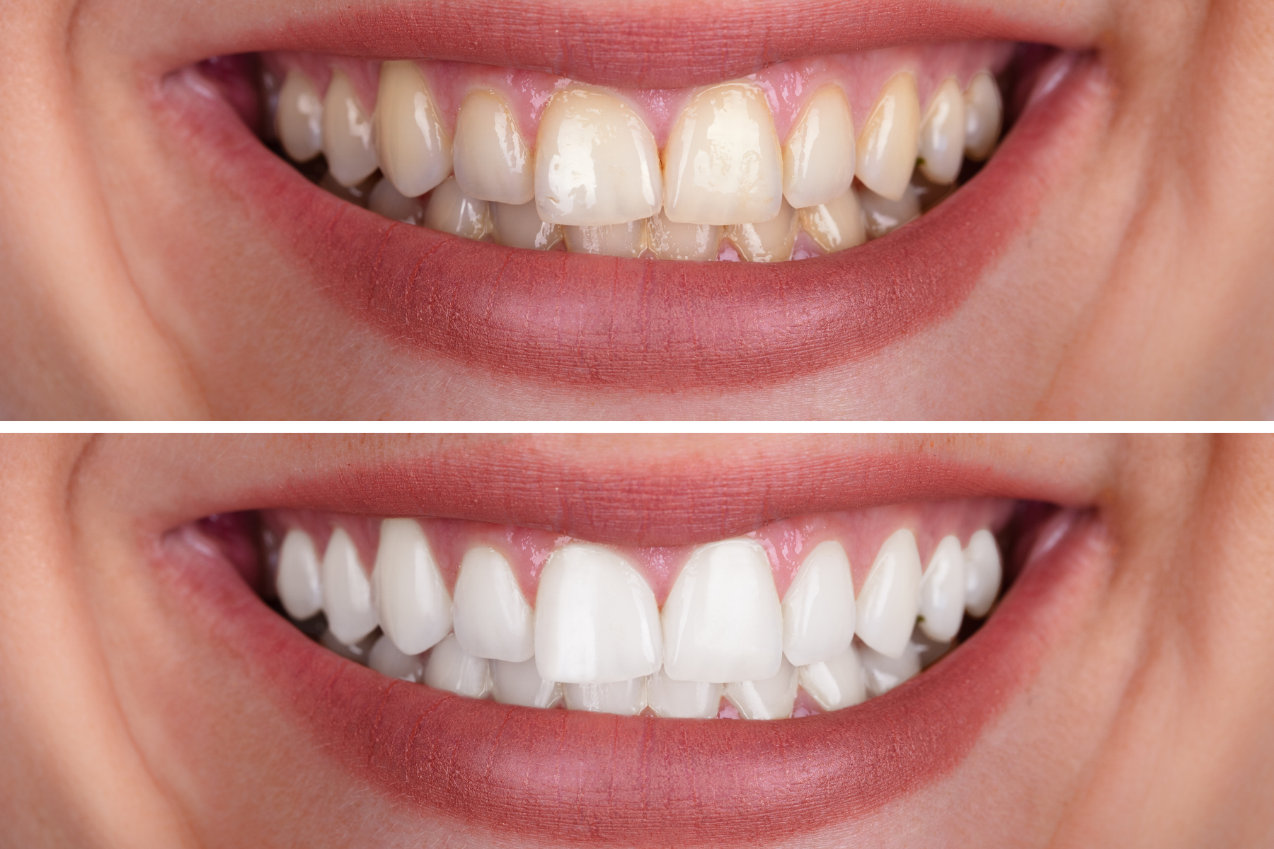 a before and after picture of a woman 's teeth .