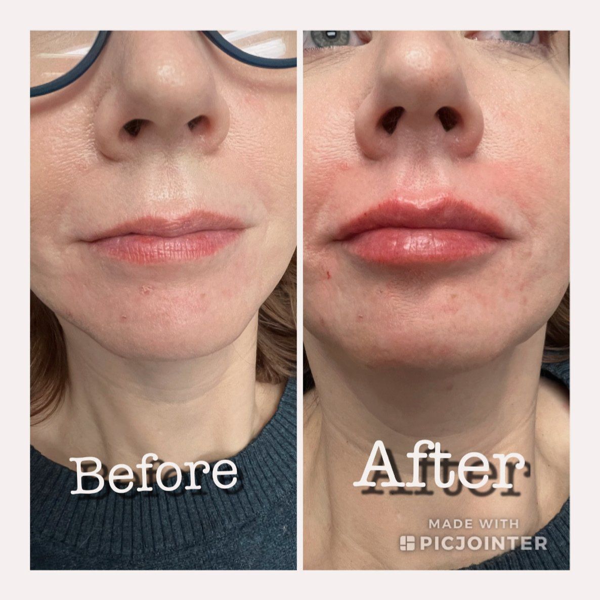 Before and After Facial Treatment — Orlando, FL — Elysium Medical Group