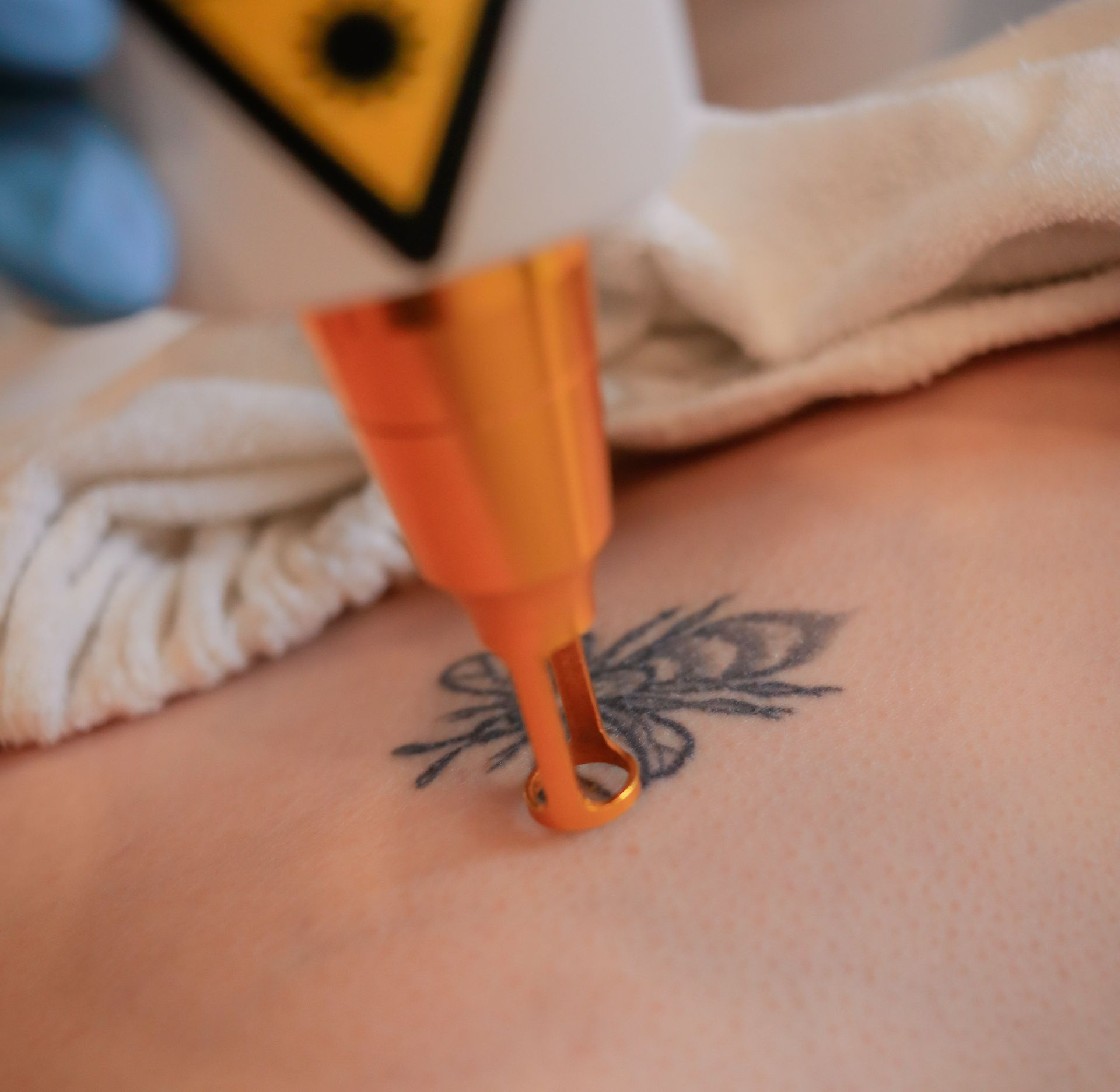 tatto removal process